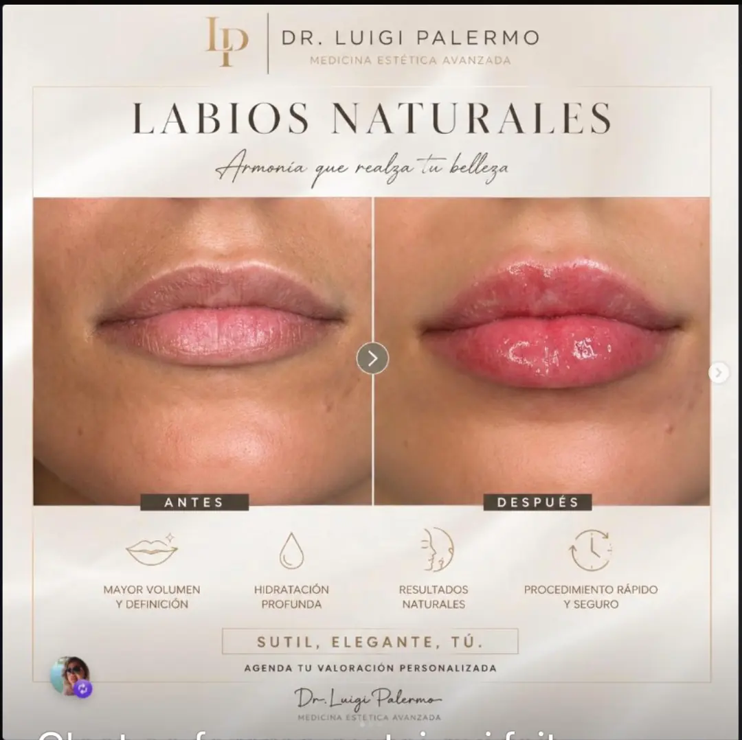 Antes y despues — aumento de labios natural, Dr. Luigi Palermo