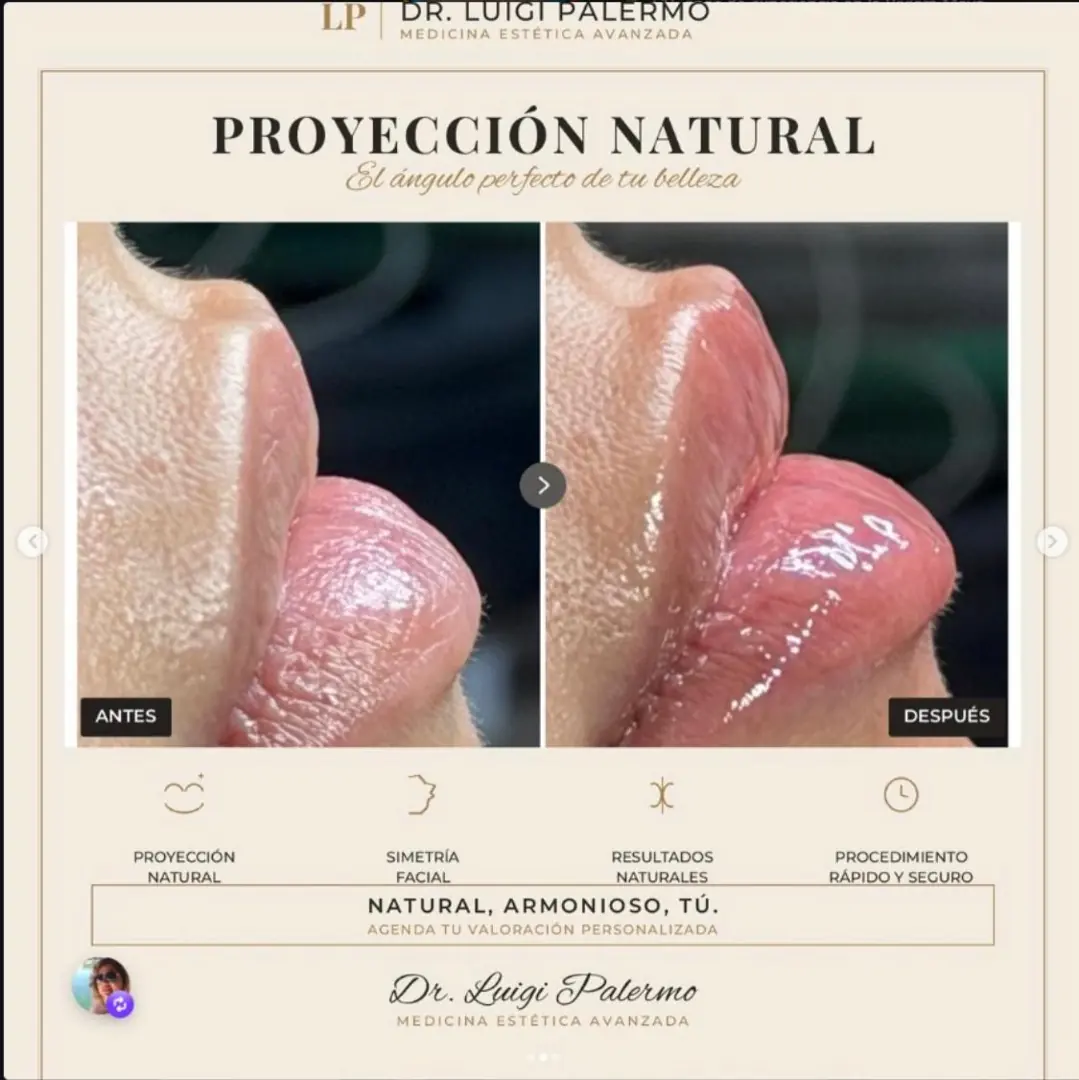 Antes y despues — proyeccion natural de labios, Dr. Luigi Palermo